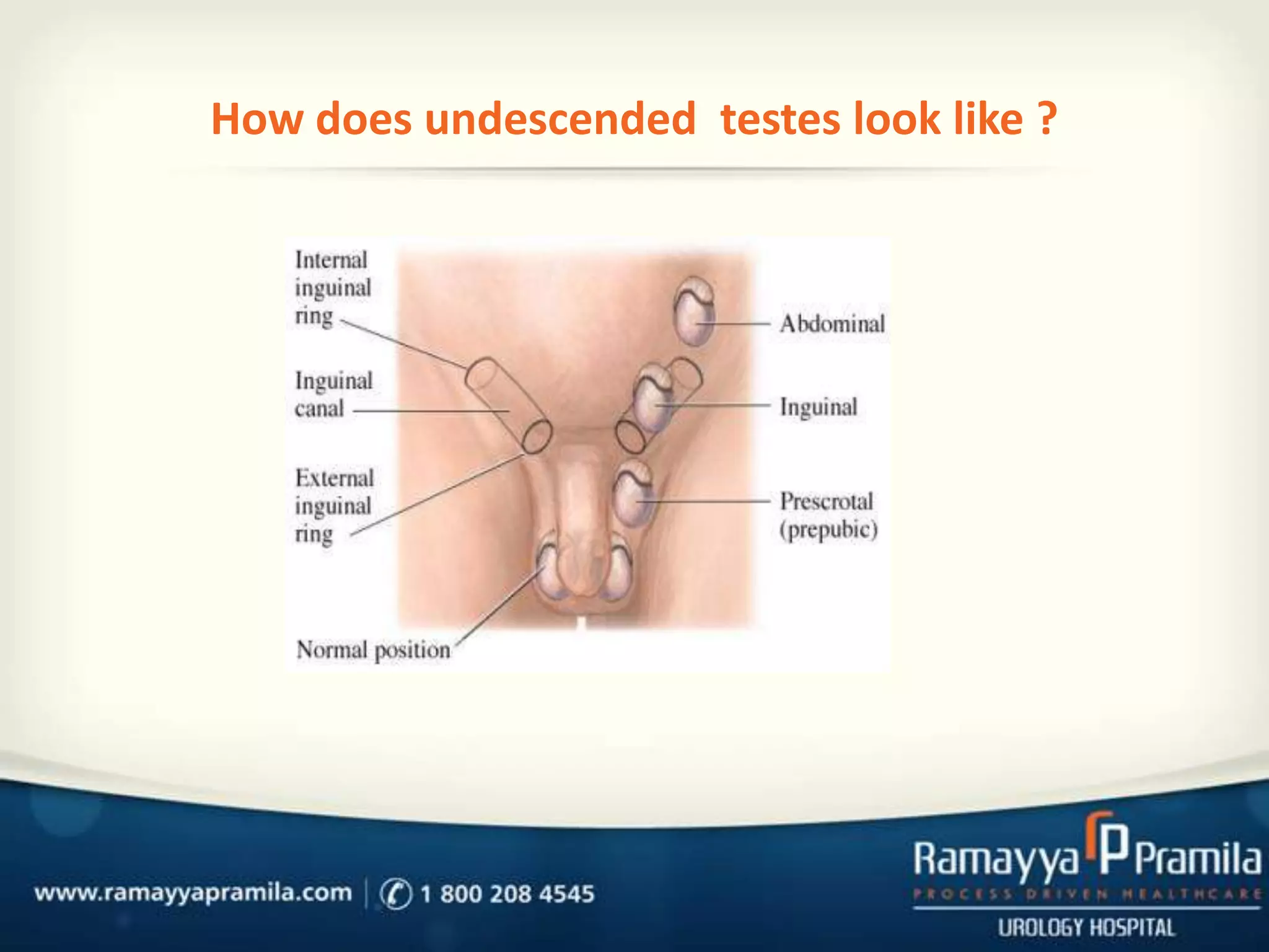 How does undescended testes look like ?

 