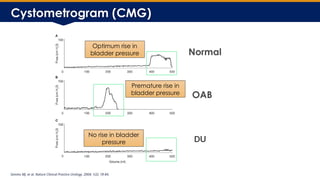 Underactive Bladder Management DGM Slides[1].pptx