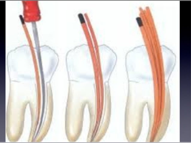 root canal filling material