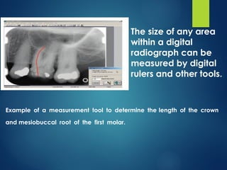 Bone Length Radiograph With Ruler Comprehensive Overview of Digital Imaging in Radiography: Techniques ...
