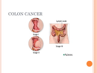 COLON CANCER
 
