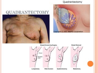 QUADRANTECTOMY
 