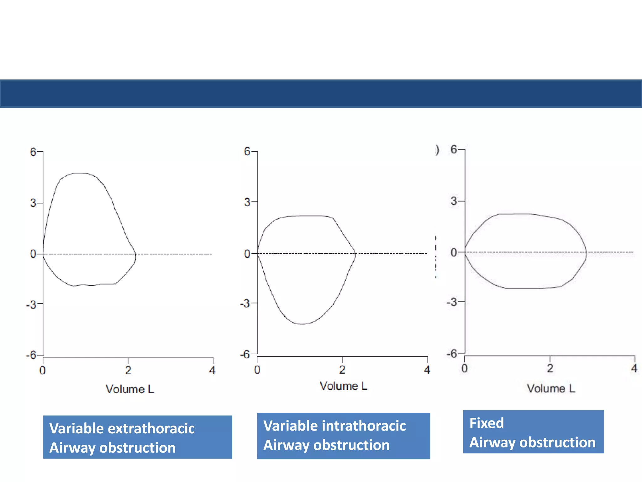 Fixed 
Airway obstruction 
Variable extrathoracic 
Airway obstruction 
Variable intrathoracic 
Airway obstruction 
 