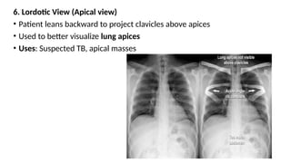 Lordotic View Comprehensive Guide to Understanding and Interpreting X-rays in Medical ...