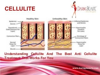 Free Powerpoint Templates
Page 1
www.daringbeaute.com
CELLULITE
Understanding Cellulite And The Best Anti Cellulite
Treatment That Works For You
 