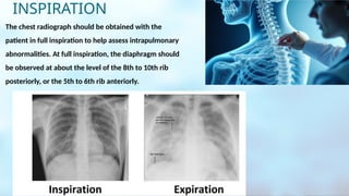 Inspiration Normal Ribs Chest X-ray Interpretation | PPTX