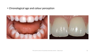 • Chronological age and colour perception
The science and art of porcelain laminate veneers - Galip Gurel 16
 
