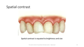 Spatial contrast
Spatial contrast is equated to brightness and size
The science and art of porcelain laminate veneers - Galip Gurel 33
 