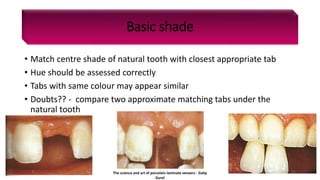 Basic shade
• Match centre shade of natural tooth with closest appropriate tab
• Hue should be assessed correctly
• Tabs with same colour may appear similar
• Doubts?? - compare two approximate matching tabs under the
natural tooth
The science and art of porcelain laminate veneers - Galip
Gurel
51
 
