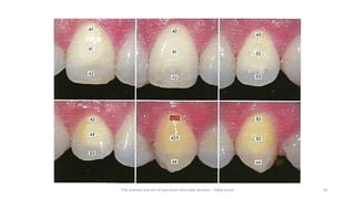 The science and art of porcelain laminate veneers - Galip Gurel 65
 