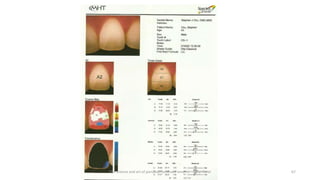 The science and art of porcelain laminate veneers - Galip Gurel 67
 