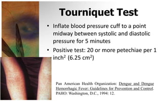 Tourniquet Test
• Inflate blood pressure cuff to a point
  midway between systolic and diastolic
  pressure for 5 minutes
• Positive test: 20 or more petechiae per 1
  inch2 (6.25 cm2)



   Pan American Health Organization: Dengue and Dengue
   Hemorrhagic Fever: Guidelines for Prevention and Control.
   PAHO: Washington, D.C., 1994: 12.
 