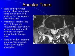Anular Repad Understanding disorders of the spine| anatomy of the spine | chronic ...
