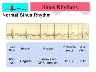 Sinus R1 Understanding ecg | PPT