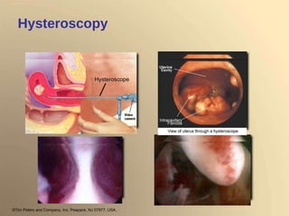 Hysteroscopy Polyp Septum ©Tim Peters and Company, Inc. Peapack, NJ 07977, USA. 