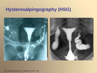 Hysterosalpingography (HSG) ©Tim Peters and Company, Inc. Peapack, NJ 07977, USA. 