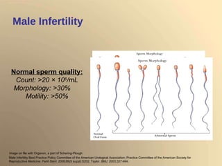 Male Infertility Normal sperm quality: Count: >20  ×  10 6 /mL Morphology: >30%  Motility: >50% Image on file with Organon, a part of Schering-Plough  Male Infertility Best Practice Policy Committee of the American Urological Association; Practice Committee of the American Society for Reproductive Medicine.  Fertil Steril . 2006;86(5 suppl):S202. Taylor.  BMJ . 2003;327:494.  