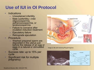 Use of IUI in OI Protocol Indications   Unexplained infertility  Male subfertility—mild oligozoospermia, asthenozoospermia, or teratozoospermia Failure to conceive after ovulation induction treatment Ejaculatory failure Retrograde ejaculation Procedure Washed prepared sperm are  deposited in the uterus just before the release of an egg or eggs in a natural or stimulated cycle Success rate: up to 15% per cycle Significant risk for multiple pregnancy Rowell and Braude.  BMJ . 2003;327:799. Image on file with Schering-Plough/Organon. 