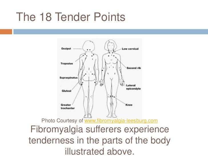 Understanding fibromyalgia