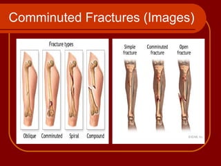Comminuted Fractures (Images) 