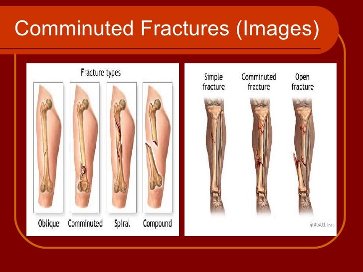 Understanding Fractures