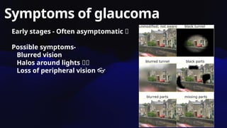 Symptoms of glaucoma
Early stages - Often asymptomatic 🙄
Possible symptoms-
Blurred vision
Halos around lights 🌈🌈
Loss of peripheral vision 👓
 