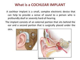 What is a COCHLEAR IMPLANT
A cochlear implant is a small, complex electronic device that
can help to provide a sense of sound to a person who is
profoundly deaf or severely hard-of-hearing.
The implant consists of an external portion that sits behind the
ear and a second portion that is surgically placed under the
skin.
 