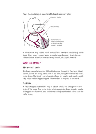 8
Figure 1: A heart attack is caused by a blockage in a coronary artery
Coronary arteries
Blocked artery
Damaged muscle.
When a coronary artery
is blocked, the heart
muscle is damaged
A heart attack may also be called a myocardial infarction or coronary throm-
bosis. Other terms you may come across include: Coronary heart disease,
Ischemic heart disease, Coronary artery disease, or Angina pectoris.
What is a stroke?
The normal brain
The brain can only function if blood is ﬂowing through it. Two large blood
vessels, which run along either side of the neck, bring blood from the heart
to the brain. The blood vessels branch off and get smaller and smaller, until
tiny blood vessels supply oxygen and nutrients to all parts of the brain.
A stroke
A stroke happens in the same way as a heart attack, but takes place in the
brain. If the blood ﬂow to the brain is interrupted, the brain loses its supply
of oxygen and nutrients. This causes the damage to the brain tissue that we
call a stroke.
 