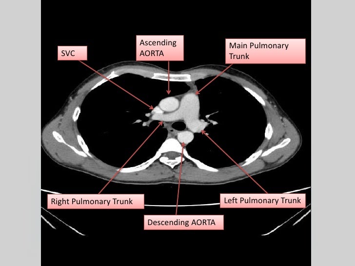 Understanding hrct