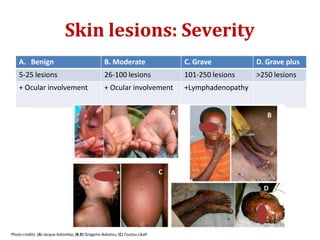 Skin lesions: Severity
A. Benign B. Moderate C. Grave D. Grave plus
5-25 lesions 26-100 lesions 101-250 lesions >250 lesions
+ Ocular involvement + Ocular involvement +Lymphadenopathy
Photo credits: (A) Jacque Katomba; (B,D) Gregoire Boketsu; (C) Toutou Likafi
 