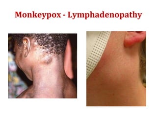 Monkeypox - Lymphadenopathy
 