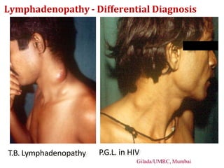 T.B. Lymphadenopathy P.G.L. in HIV
Gilada/UMRC, Mumbai
Lymphadenopathy - Differential Diagnosis
 
