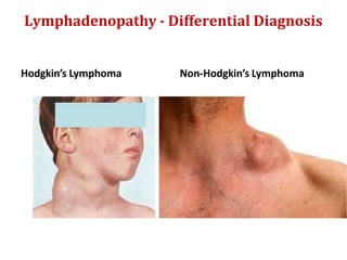 Lymphadenopathy - Differential Diagnosis
Hodgkin’s Lymphoma Non-Hodgkin’s Lymphoma
 