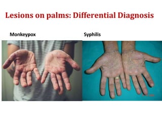 Lesions on palms: Differential Diagnosis
Monkeypox Syphilis
 