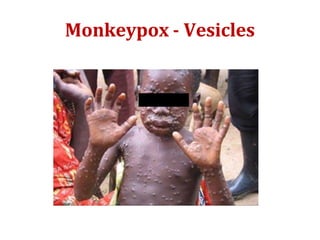 Monkeypox - Vesicles
 