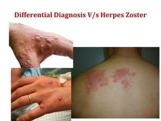 Differential Diagnosis V/s Herpes Zoster
 