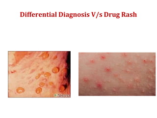 Differential Diagnosis V/s Drug Rash
 