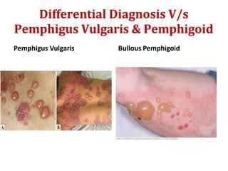 Differential Diagnosis V/s
Pemphigus Vulgaris & Pemphigoid
Pemphigus Vulgaris Bullous Pemphigoid
 