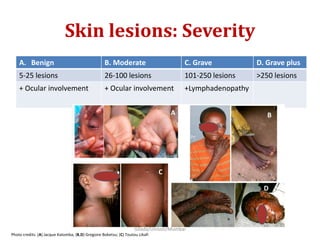Skin lesions: Severity
A. Benign B. Moderate C. Grave D. Grave plus
5-25 lesions 26-100 lesions 101-250 lesions >250 lesions
+ Ocular involvement + Ocular involvement +Lymphadenopathy
Photo credits: (A) Jacque Katomba; (B,D) Gregoire Boketsu; (C) Toutou Likafi
Gilada/Unison/Mumbai
 