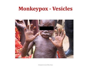 Monkeypox - Vesicles
Gilada/Unison/Mumbai
 