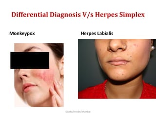 Differential Diagnosis V/s Herpes Simplex
Monkeypox Herpes Labialis
Gilada/Unison/Mumbai
 