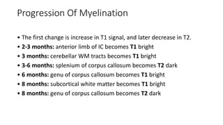 Progression Of Myelination
• The first change is increase in T1 signal, and later decrease in T2.
• 2-3 months: anterior limb of IC becomes T1 bright
• 3 months: cerebellar WM tracts becomes T1 bright
• 3-6 months: splenium of corpus callosum becomes T2 dark
• 6 months: genu of corpus callosum becomes T1 bright
• 8 months: subcortical white matter becomes T1 bright
• 8 months: genu of corpus callosum becomes T2 dark
 