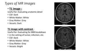 Types of MR Images
• T1 image :
Useful for: Evaluating anatomic detail
• CSF: Dark
• White Matter: White
• Gray Matter: Gray
• Vessels: Dark
T1 image with contrast :
Useful for: Evaluating for BBB breakdown
• in the setting of tumor, infection, etc.
• CSF: Dark
• White Matter: White
• Gray Matter: Gray
• Vessels: Bright
 