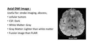 Axial DWI image :
Useful for: stroke imaging, abscess,
• cellular tumors
• CSF: Dark
• White Matter: Gray
• Gray Matter: Lighter than white matter
• Fuzzier image than FLAIR
 