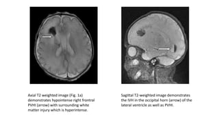 Axial T2 weighted image (Fig. 1a)
demonstrates hypointense right frontral
PVHI (arrow) with surrounding white
matter injury which is hyperintense.
Sagittal T2-weighted image demonstrates
the IVH in the occipital horn (arrow) of the
lateral ventricle as well as PVHI.
 