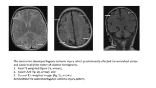 This term infant developed hypoxic-ischemic injury which predominantly affected the watershed cortex
and subcortical white matter of bilateral hemispheres.
1. Axial T2 weighted (figure 2a, arrows),
2. Axial FLAIR (fig. 2b, arrows) and
3. Coronal T1- weighted images (fig. 2c, arrows)
demonstrate the watershed hypoxic-ischemic injury pattern.
 