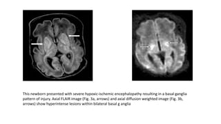 This newborn presented with severe hypoxic-ischemic encephalopathy resulting in a basal ganglia
pattern of injury. Axial FLAIR image (Fig. 3a, arrows) and axial diffusion weighted image (Fig. 3b,
arrows) show hyperintense lesions within bilateral basal g anglia
 