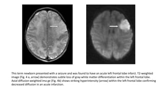 This term newborn presented with a seizure and was found to have an acute left frontal lobe infarct. T2-weighted
image (Fig. 4 a, arrow) demonstrates subtle loss of gray-white matter differentiation within the left frontal lobe.
Axial diffusion weighted ima ge (Fig. 4b) shows striking hyperintensity (arrow) within the left frontal lobe confirming
decreased diffusion in an acute infarction.
 