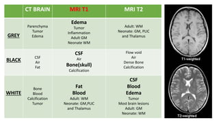 CT BRAIN MRI T1 MRI T2
GREY
Parenchyma
Tumor
Edema
Edema
Tumor
Inflammation
Adult GM
Neonate WM
Adult: WM
Neonate: GM, PLIC
and Thalamus
BLACK
CSF
Air
Fat
CSF
Air
Bone(skull)
Calcification
Flow void
Air
Dense Bone
Calcification
WHITE
Bone
Blood
Calcification
Tumor
Fat
Blood
Adult: WM
Neonate: GM,PLIC
and Thalamus
CSF
Blood
Edema
Tumor
Most brain lesions
Adult: GM
Neonate: WM
 