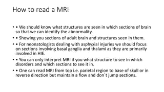 How to read a MRI
• • We should know what structures are seen in which sections of brain
so that we can identify the abnormality.
• • Showing you sections of adult brain and structures seen in them.
• • For neonatologists dealing with asphyxial injuries we should focus
on sections involving basal ganglia and thalami as they are primarily
involved in HIE.
• • You can only interpret MRI if you what structure to see in which
disorders and which sections to see it in.
• • One can read MRI from top i.e. parietal region to base of skull or in
reverse direction but maintain a flow and don`t jump sections.
 